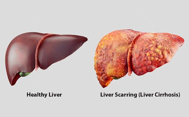 How alcohol consumption affect your liver?